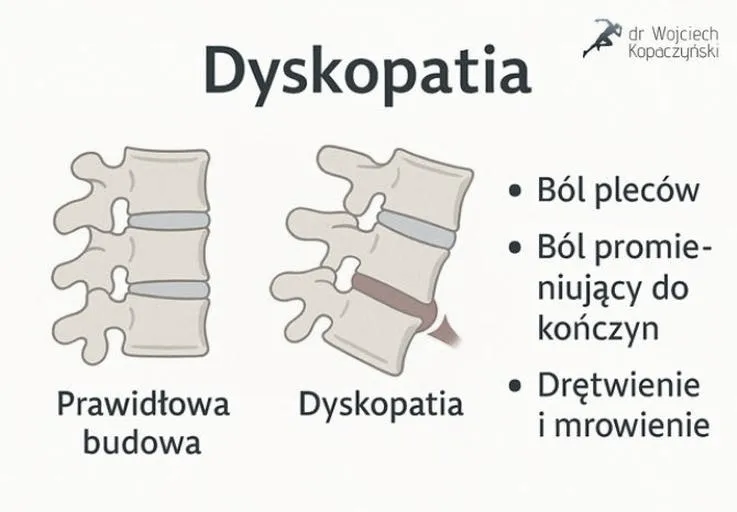 Czy przy dyskopatii można biegać i jak robić to bezpiecznie