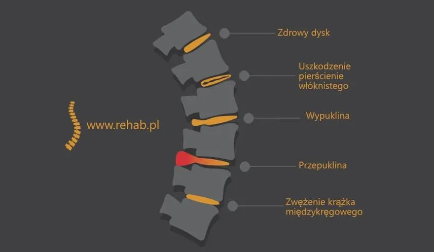 Dyskopatia lędźwiowa