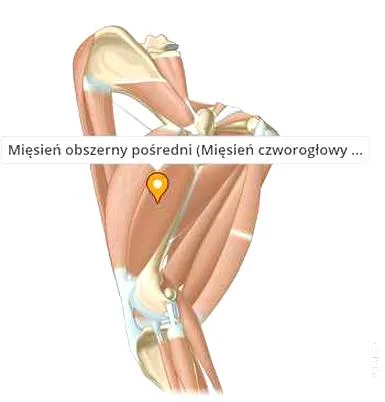 Naciągnięty mięsień czworogłowy uda